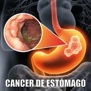 Cáncer de Estómago