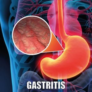 gastritis