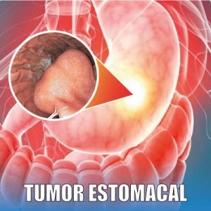 tumor estomacal