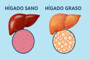 Diferencia entre hígado sano e hígado graso